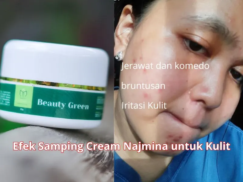 5 Efek Samping Cream Najmina yang Sering Dikhawatirkan Pengguna